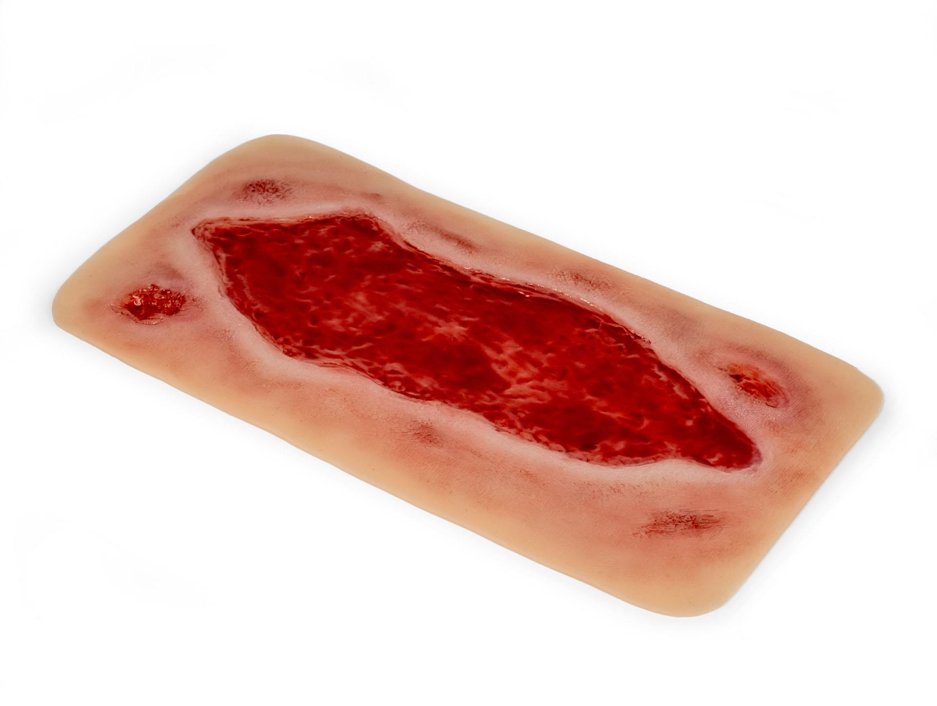 Wound-moulage-arterial-leg-ulcer-large-granulation-phase-3