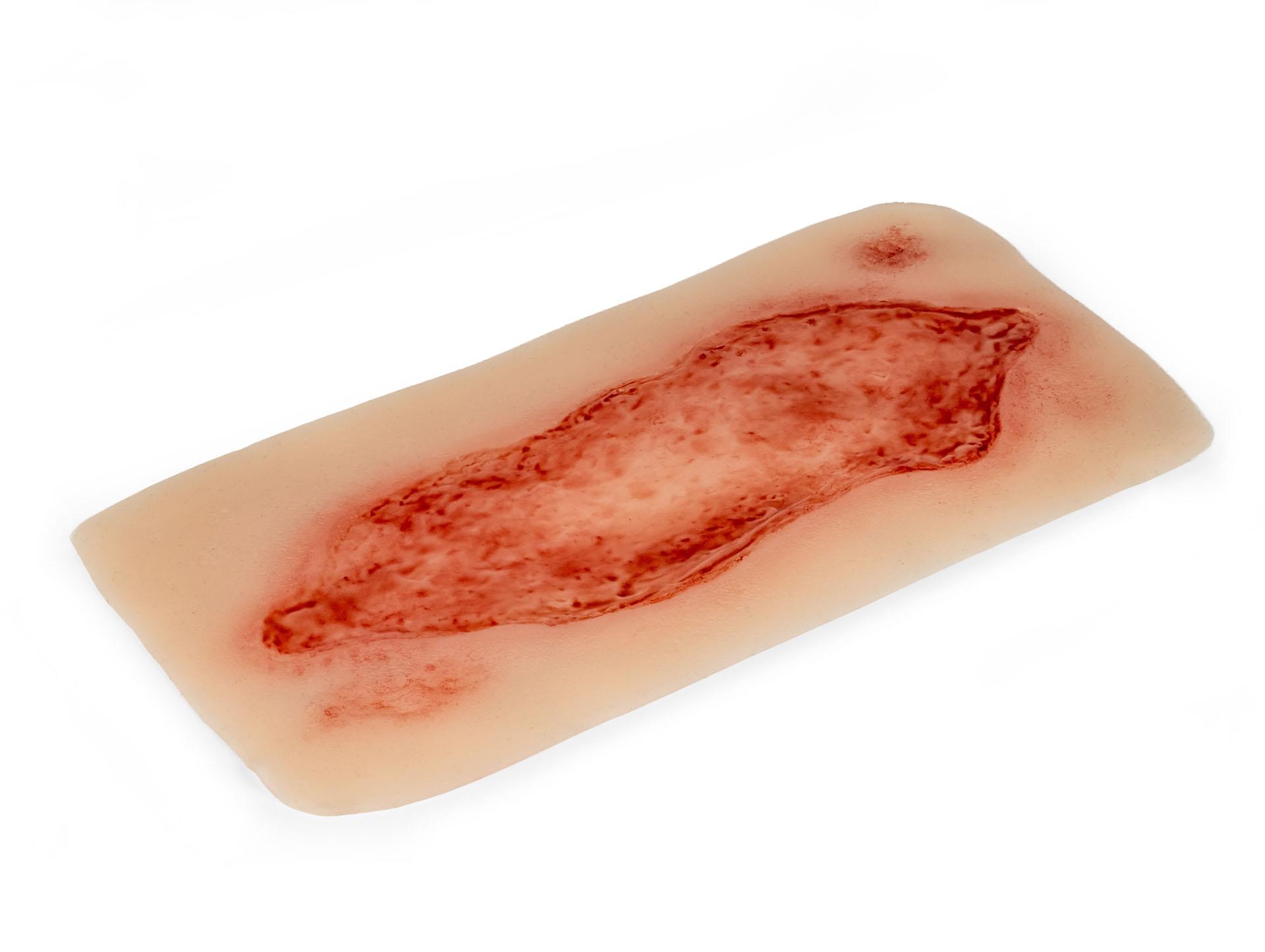 Wundmoulage-Ulcus-Cruris-Arteriosum-groß-Epithelisierungsphase-2