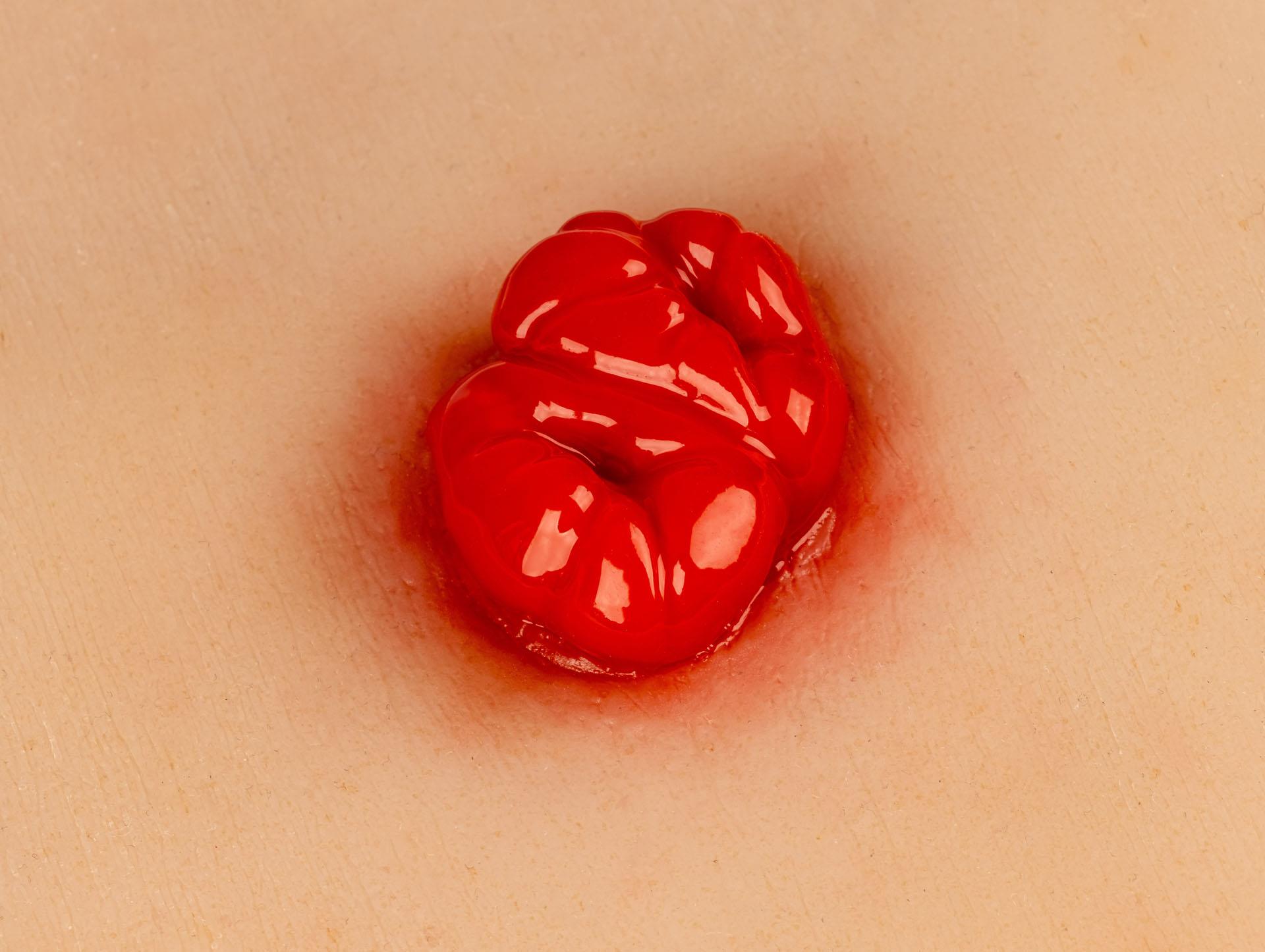 Wundmoulage-Kolostoma-doppelläufig-inkl-Stativ-2