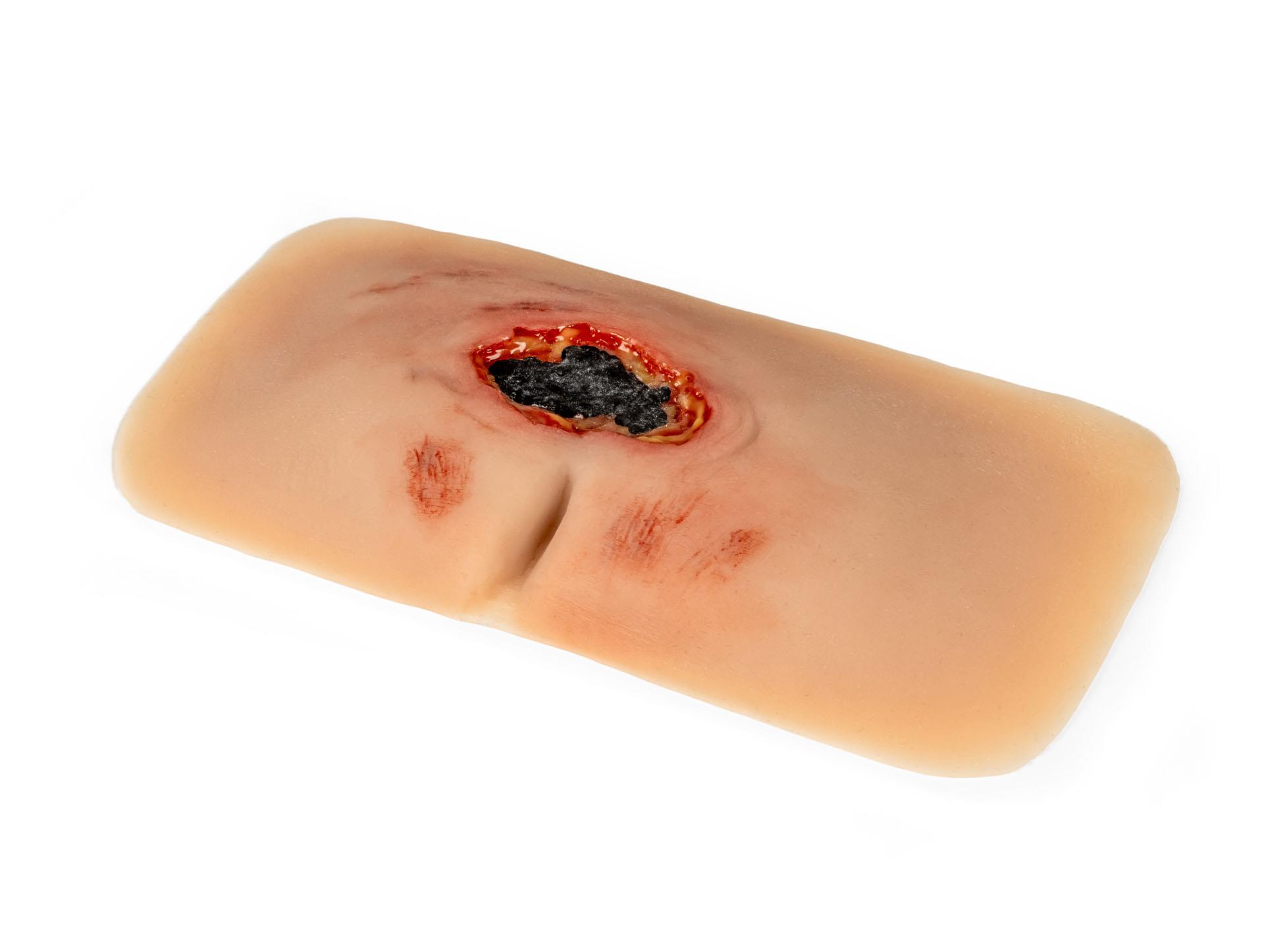Wundmoulage-sakraler-Dekubitus-unbehandelt-3