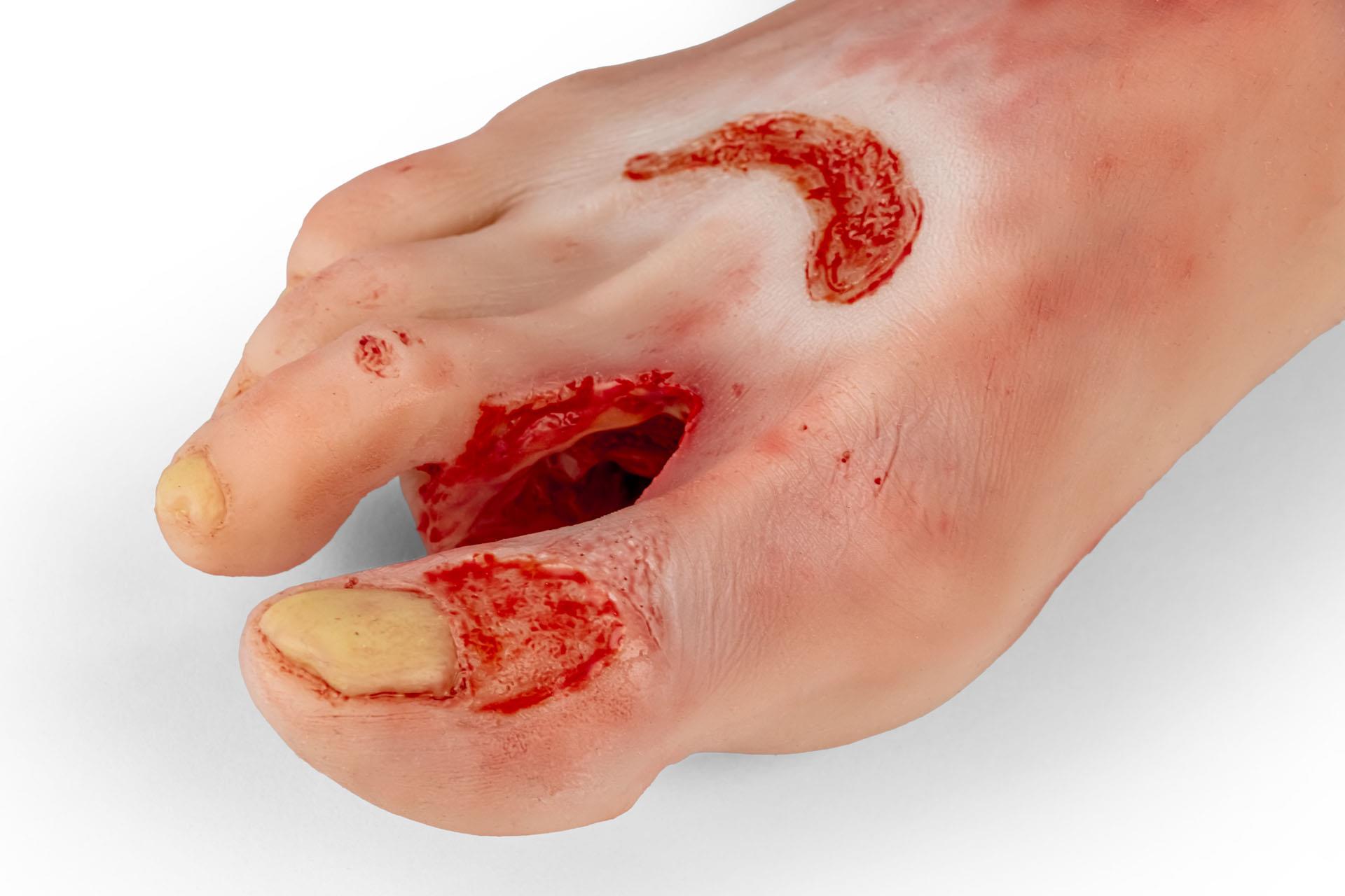 Wundenfuß-mit-diabetischem-Fußsyndrom-fortg-Stadium-für-Nursing-Anne-8