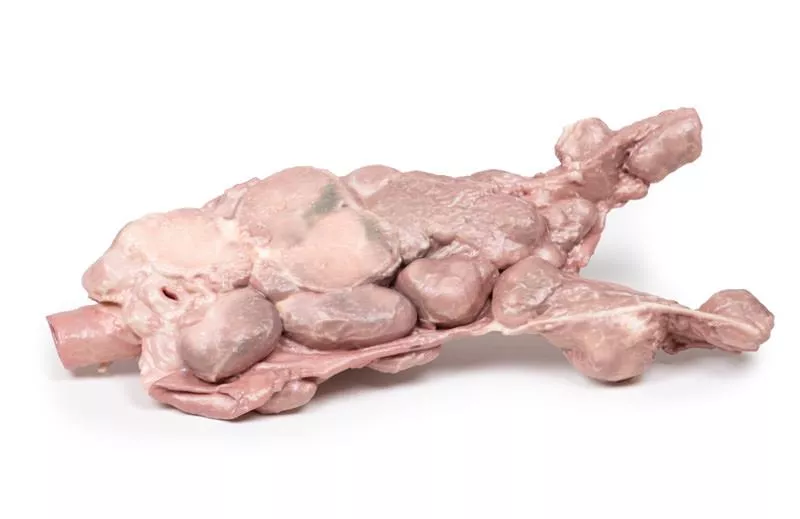 Aorta & para-aortic lymph nodes