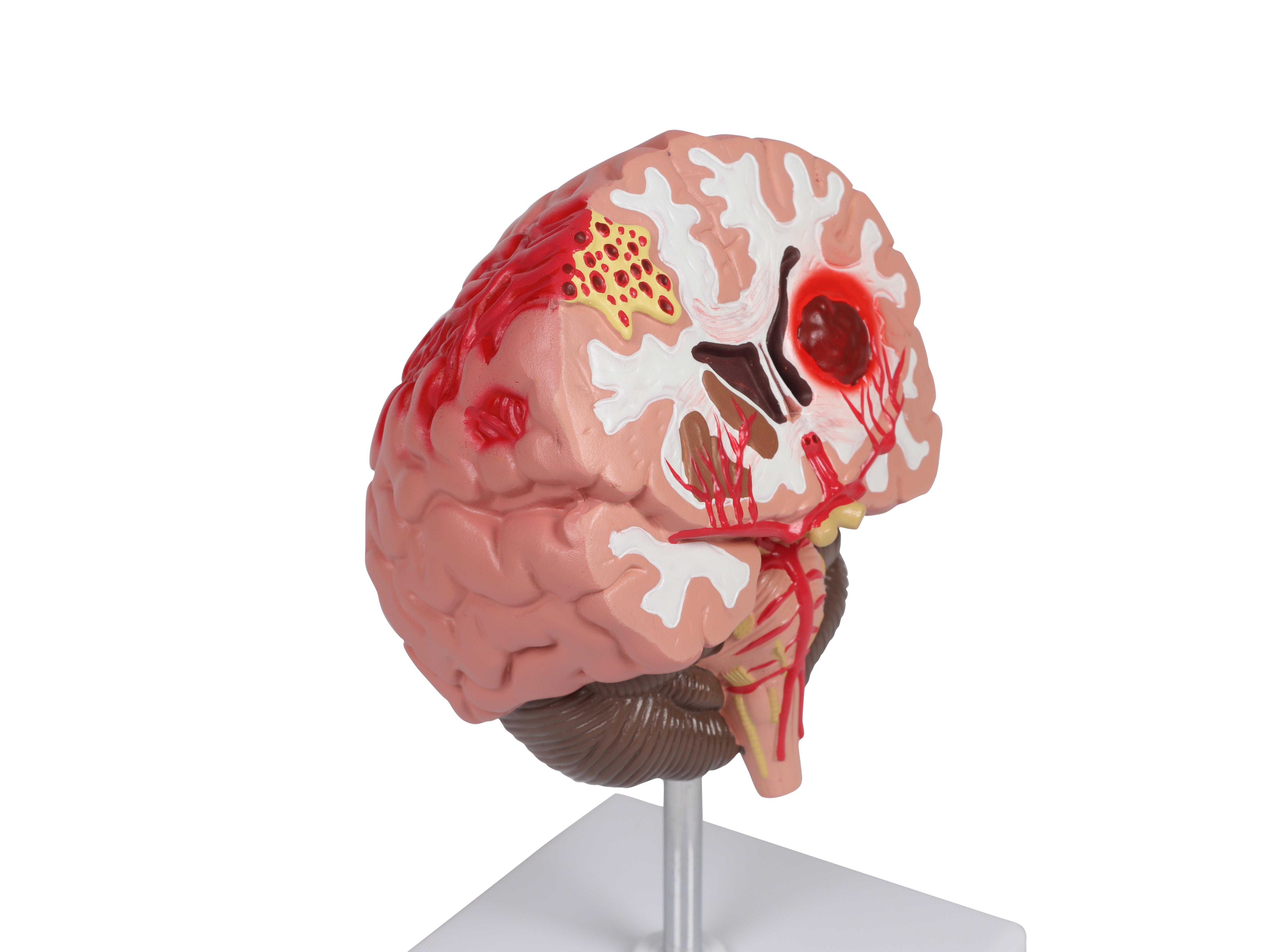 Pathologien-des-Gehirns-lebensgröße-2