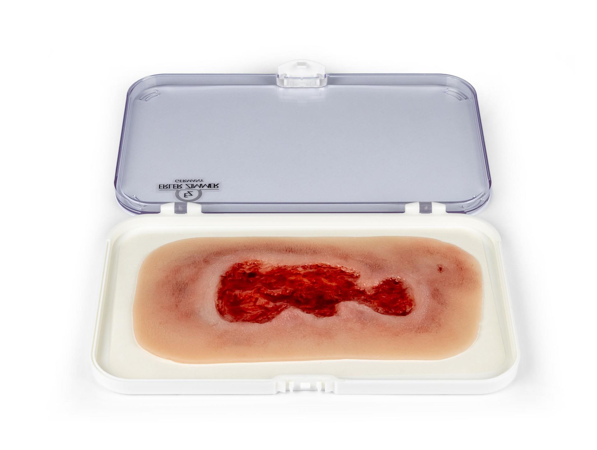 Wundmoulage-Ulcus-Cruris-Venosum-klein-Granulationsphase