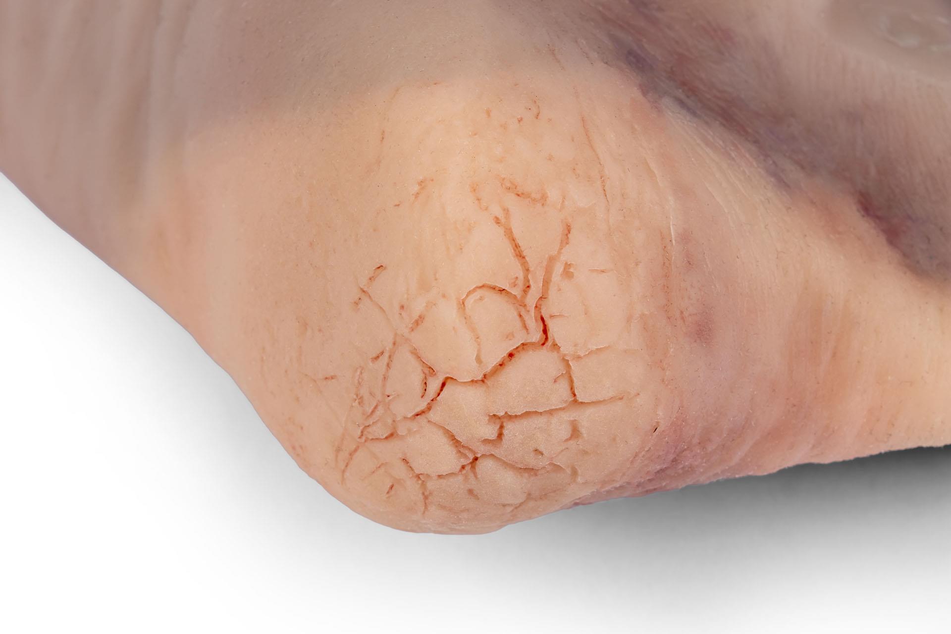Wound-foot-with-diabetic-foot-syndrome-5