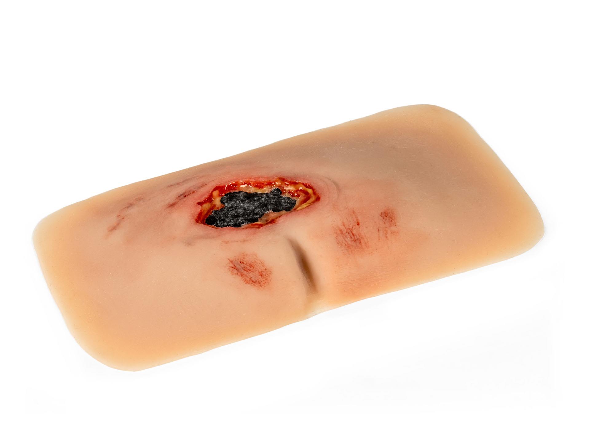 Wundmoulage-sakraler-Dekubitus-unbehandelt-2
