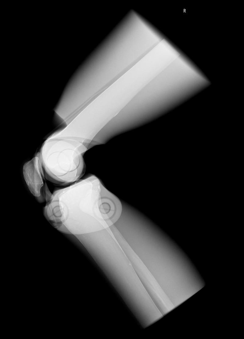 Röntgen-Teilphantom mit künstlichen Knochen - Rechtes Knie, opak