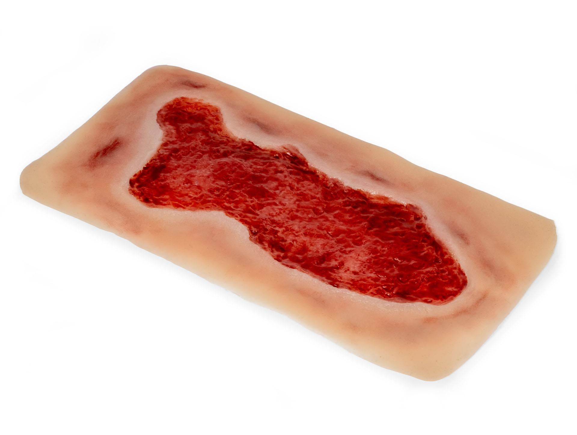 Wundmoulage-Ulcus-Cruris-Venosum-groß-Granulationsphase-3