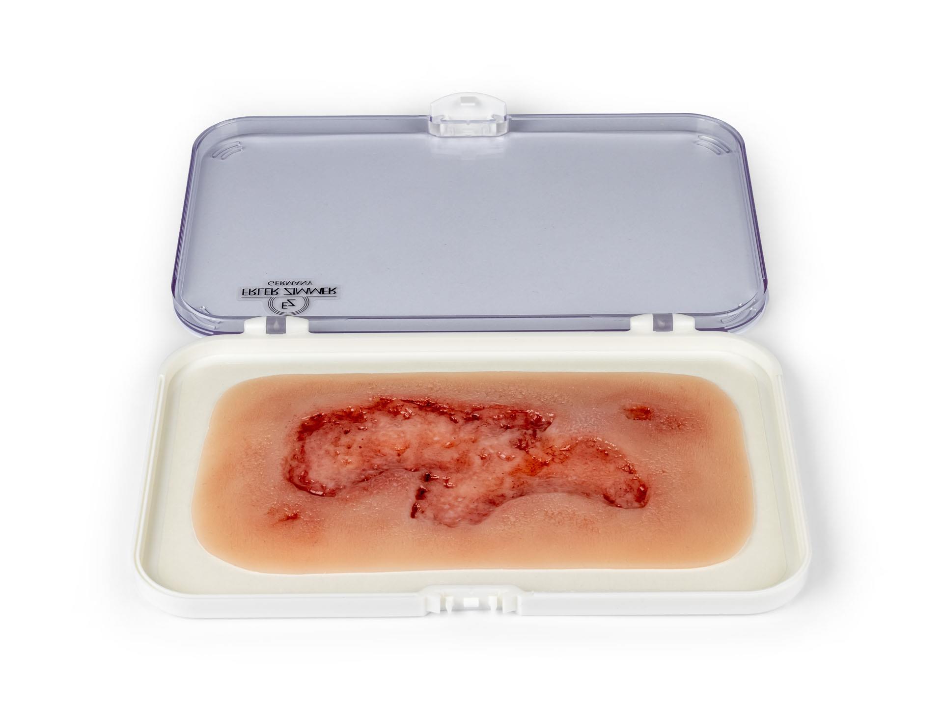 Wundmoulage-Ulcus-Cruris-Arteriosum-klein-Epithelisierungsphase