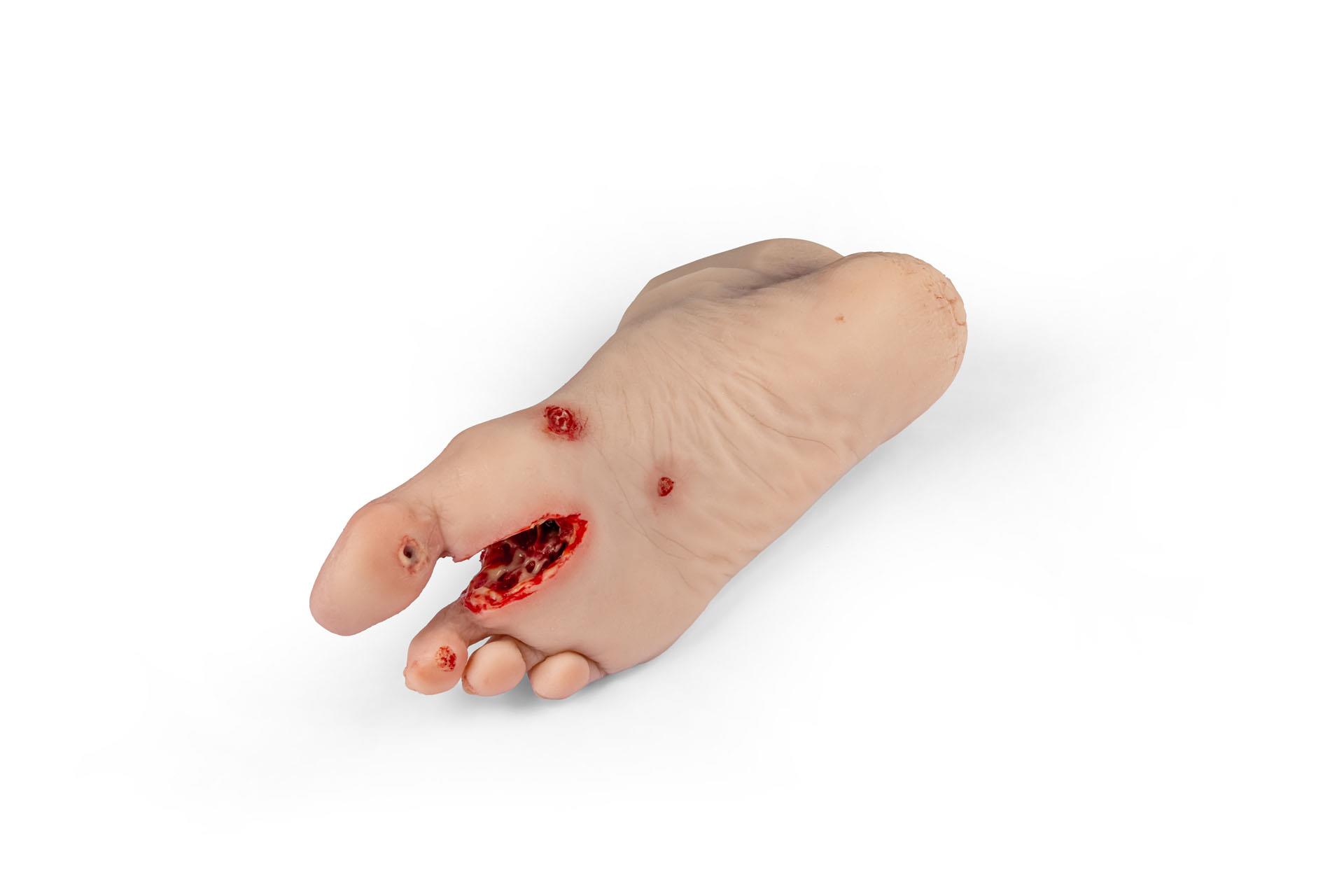 Wundenfuß-mit-diabetischem-Fußsyndrom-fortg-Stadium-für-Nursing-Anne-3