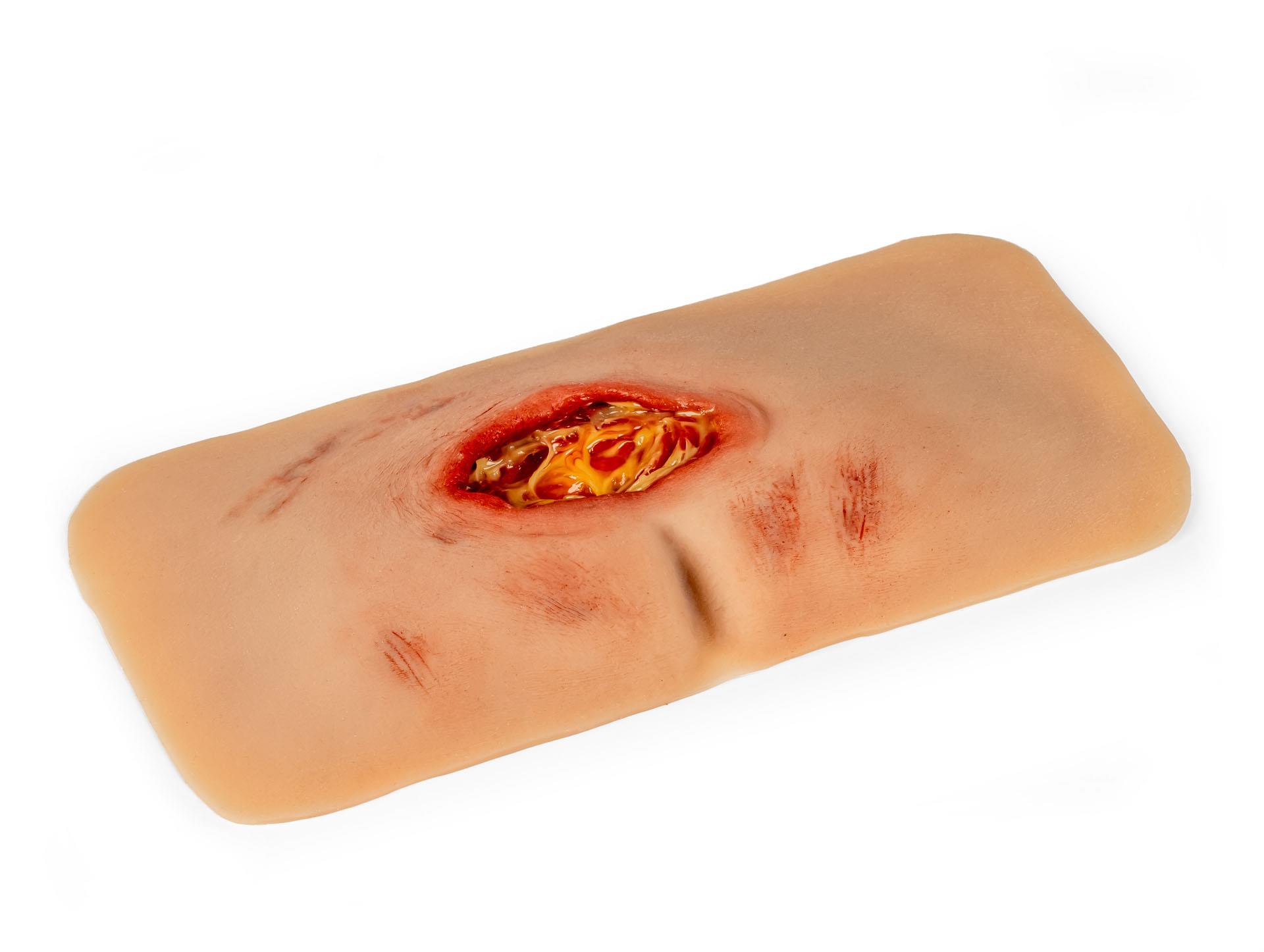 Wound-moulage-sacral-decubitus-cleaned-2