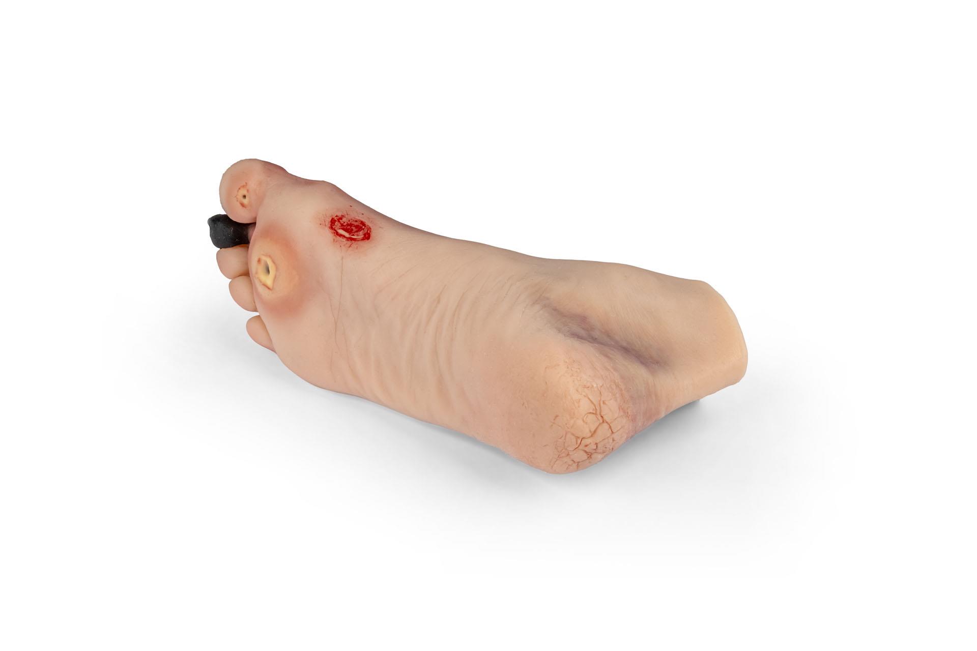 Wound-foot-with-diabetic-foot-syndrome-4