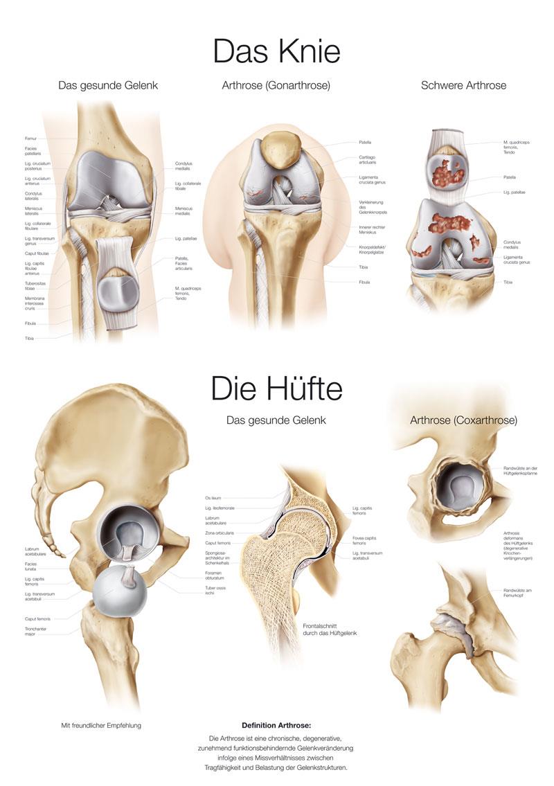 Chart The knee / The hip, 50x70cm