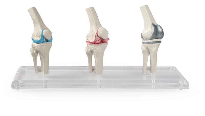 3 modèles du joint de genou - sain, malade, implant, avec support