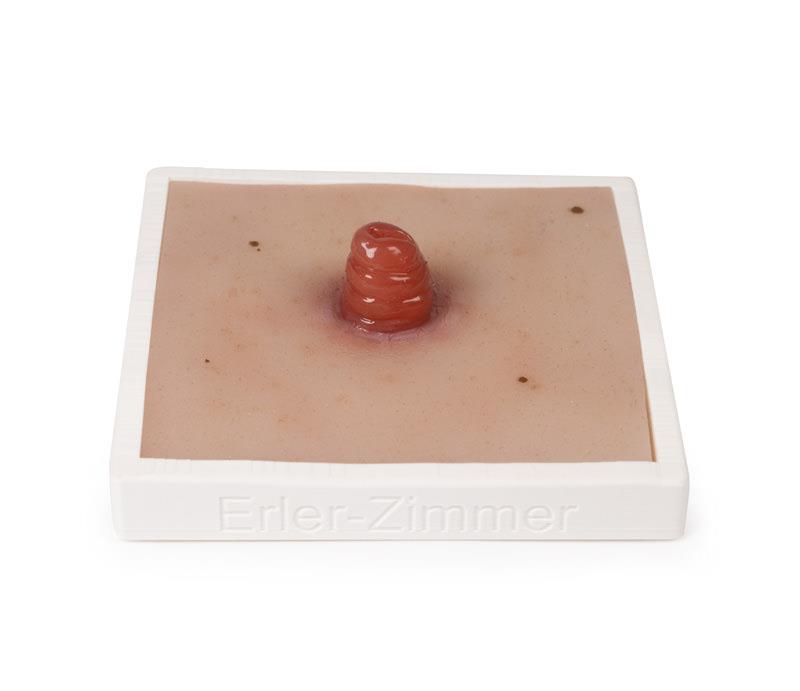 Wound Moulage Ileostoma, incl. stand