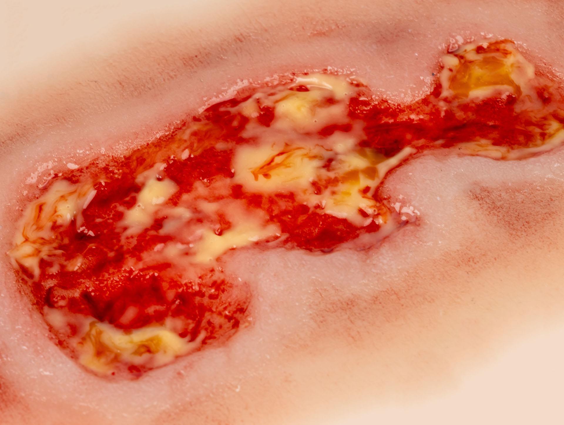 Wound-moulage-venous-leg-ulcer-small-exudation-phase-4
