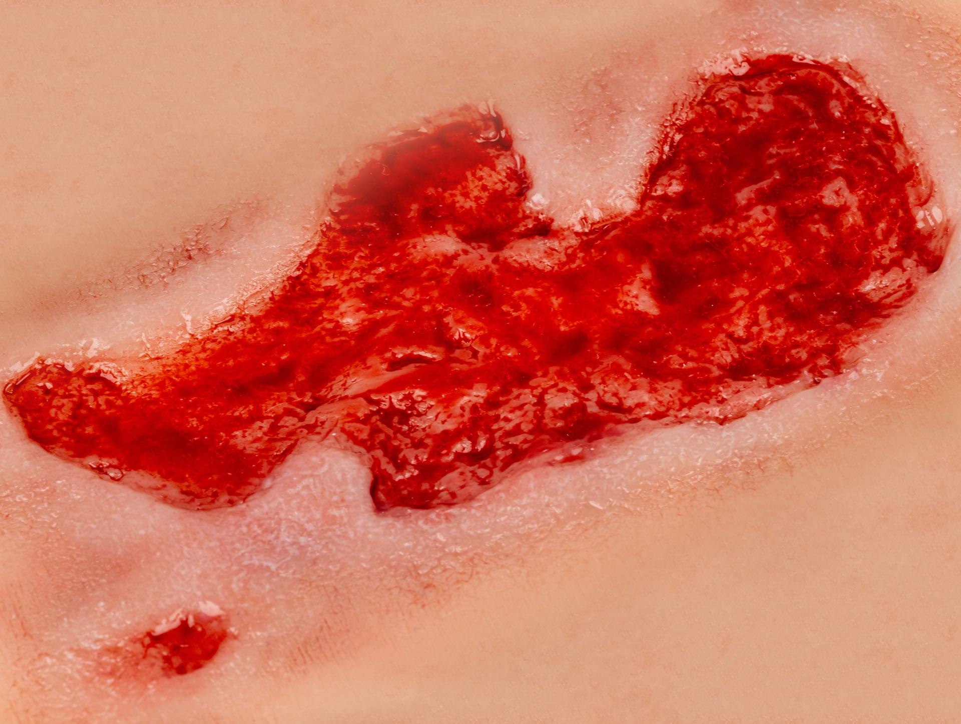 Wundmoulage-Ulcus-Cruris-Arteriosum-klein-Granulationsphase-4