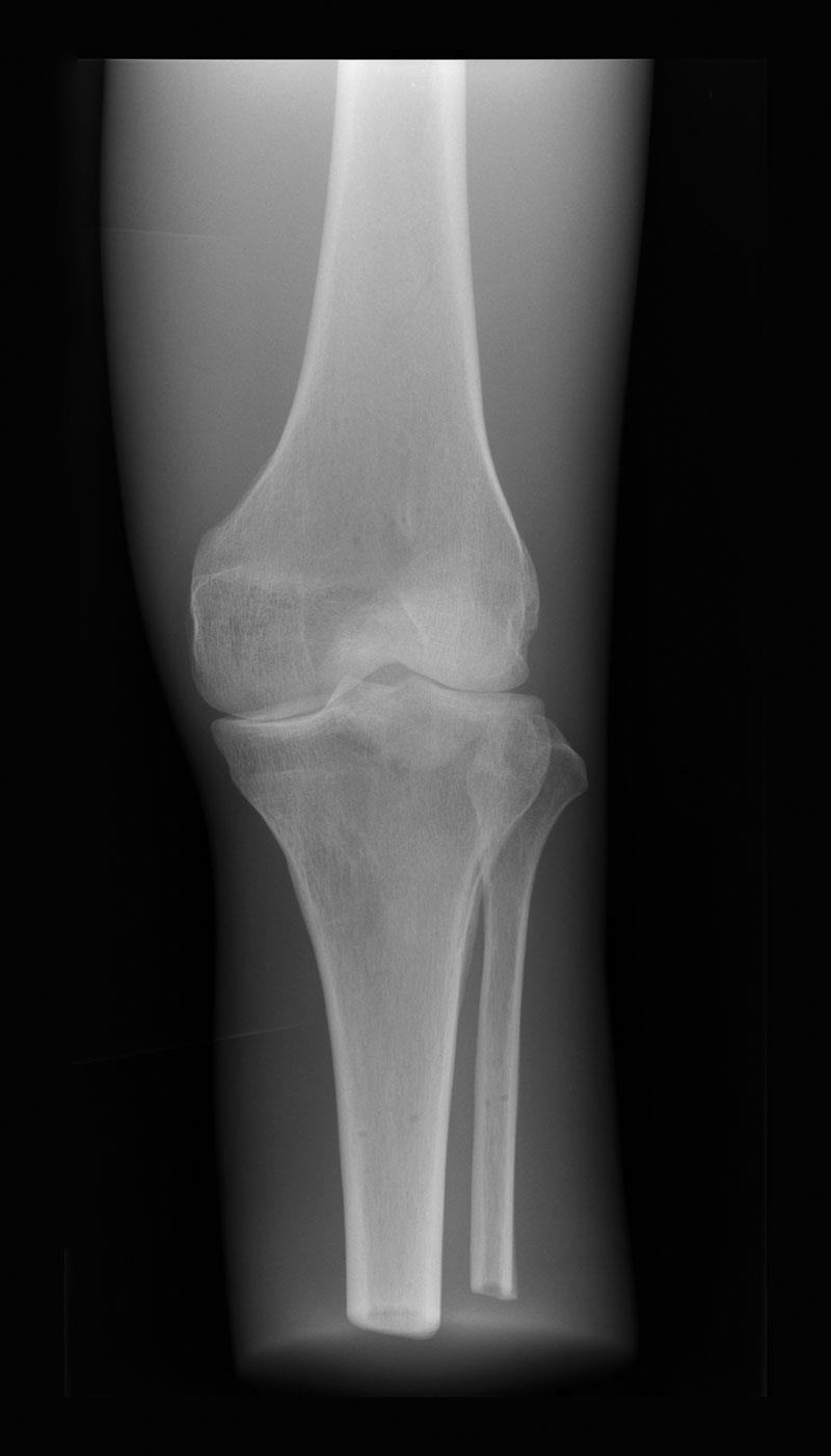 Röntgenphantom Knie, opak