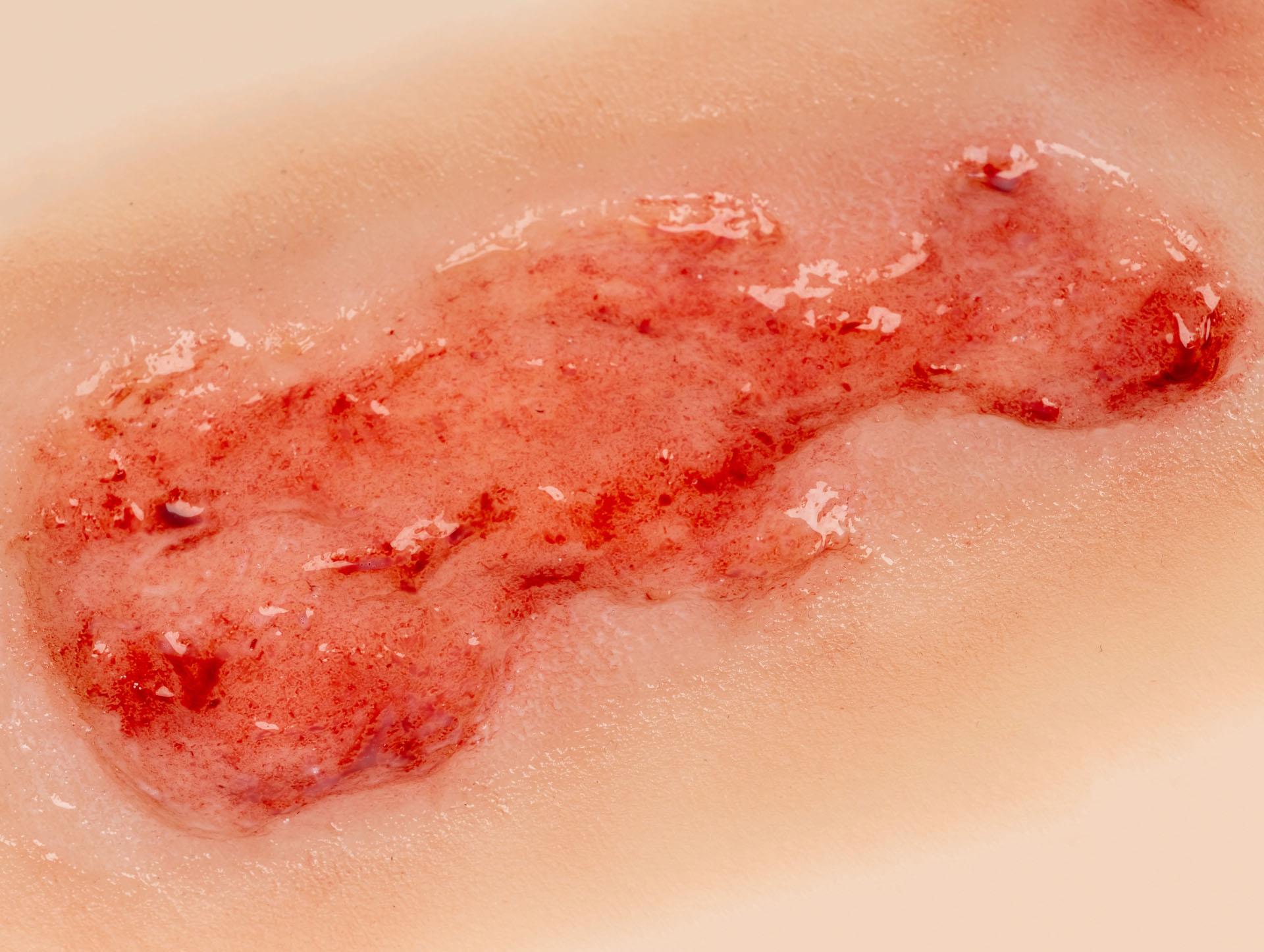 Wound-moulage-venous-leg-ulcer-small-epithelisation-phase-4