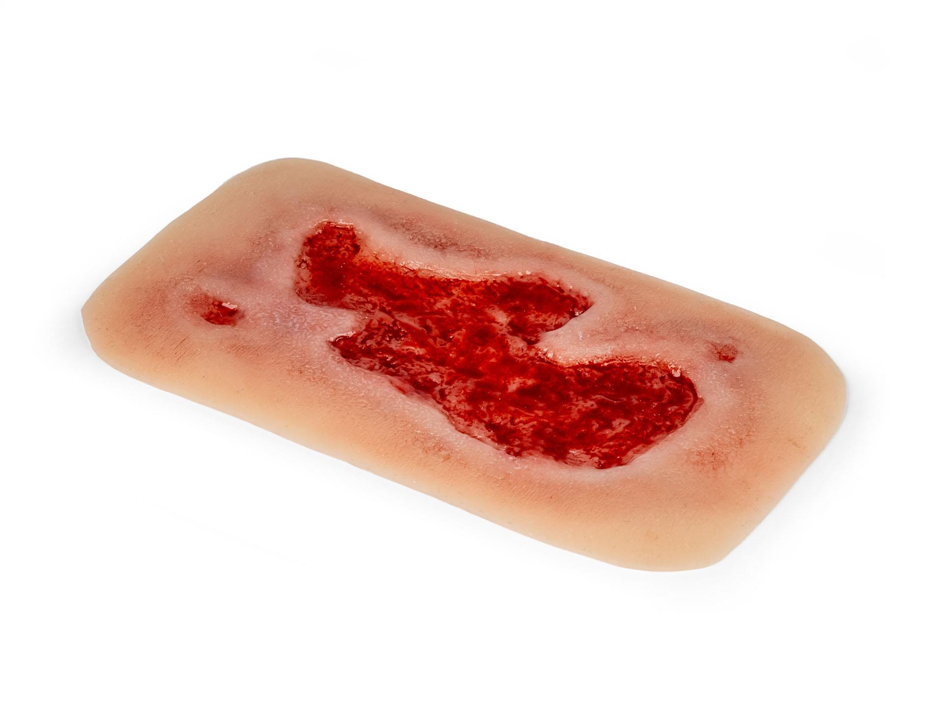 Wundmoulage-Ulcus-Cruris-Arteriosum-klein-Granulationsphase-3