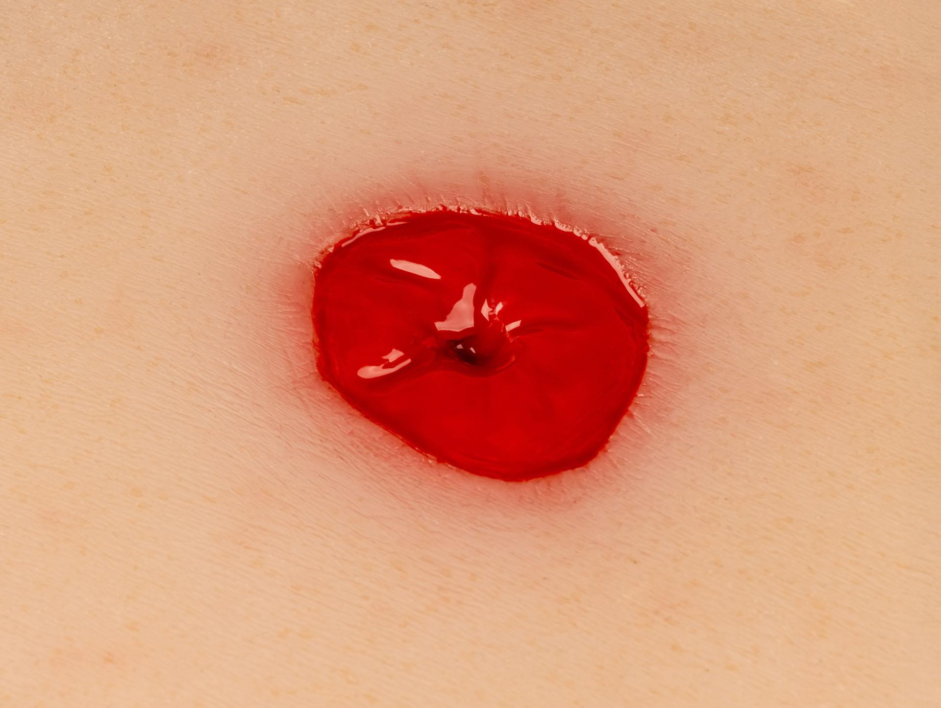 Wound-Moulage-Colostoma-under-skin-level-incl-stand-2