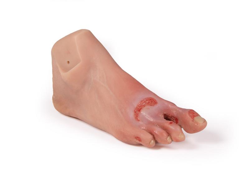 Wound-foot-with-diabetic-foot-syndrome-severe-stage-Nurisng-Anne-version