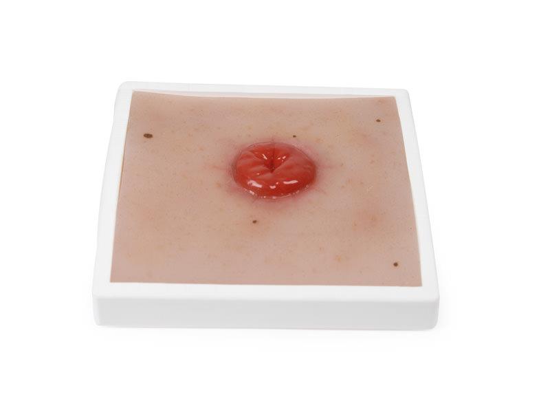 Wound Moulage Colostoma, incl. stand