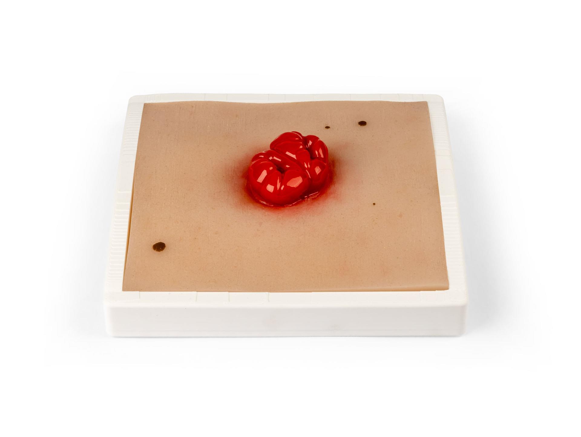 Wundmoulage-Kolostoma-doppelläufig-inkl-Stativ-1