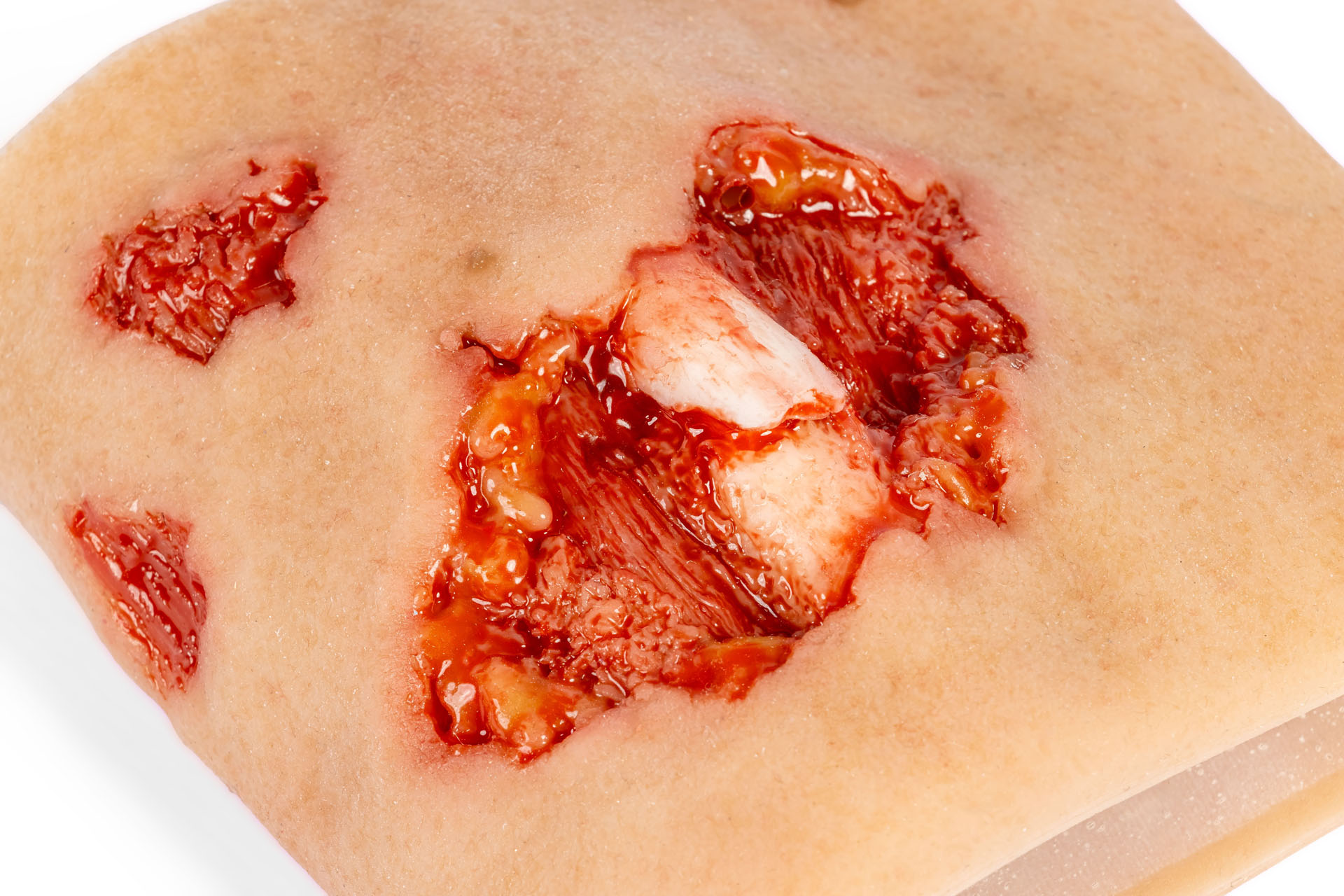 Wound Moulage Sleeve for Open Upper Arm Fracture, with Bleeding Feature