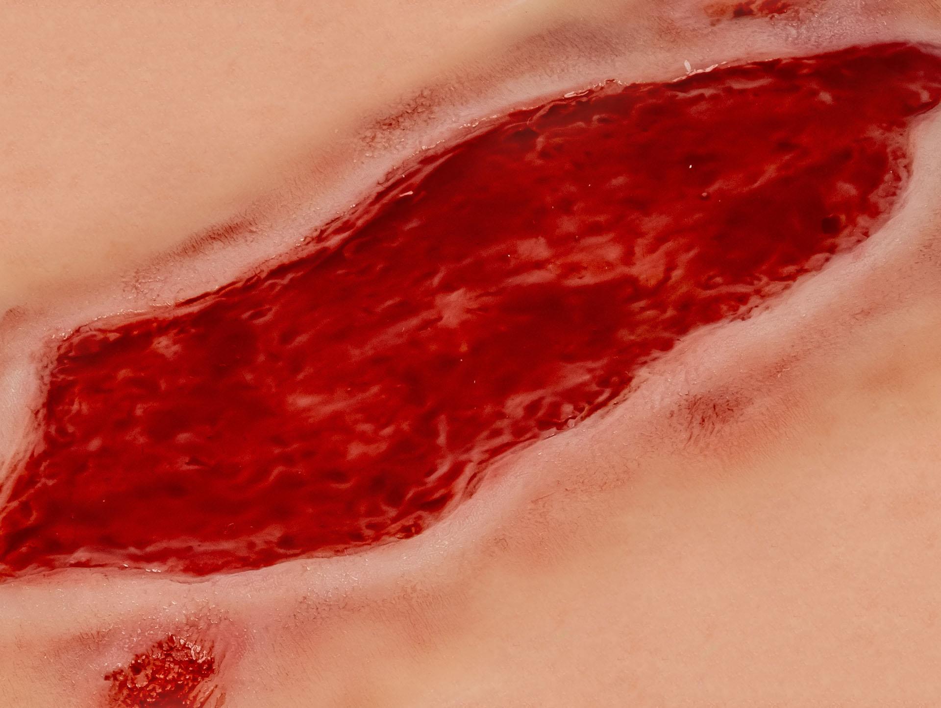 Wound-moulage-arterial-leg-ulcer-large-granulation-phase-4