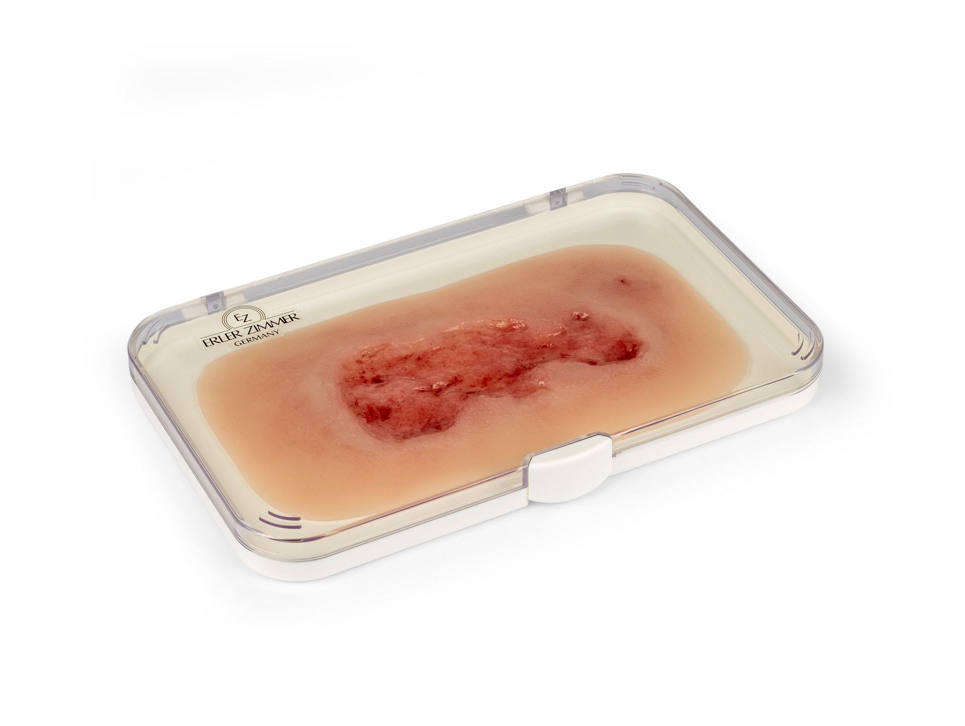 Wound-moulage-venous-leg-ulcer-small-epithelisation-phase-1