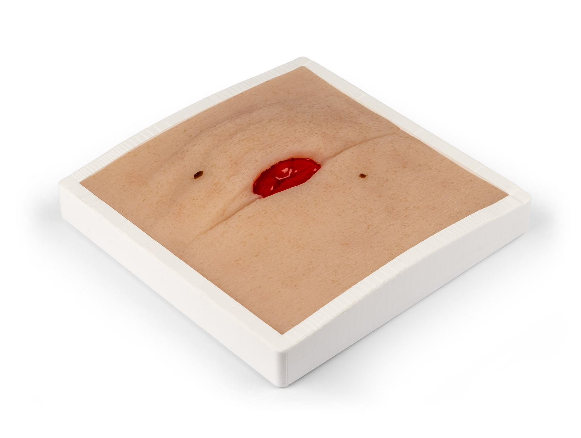 Wound-Moulage-Colostoma-in-abdominal-crease-incl-stand