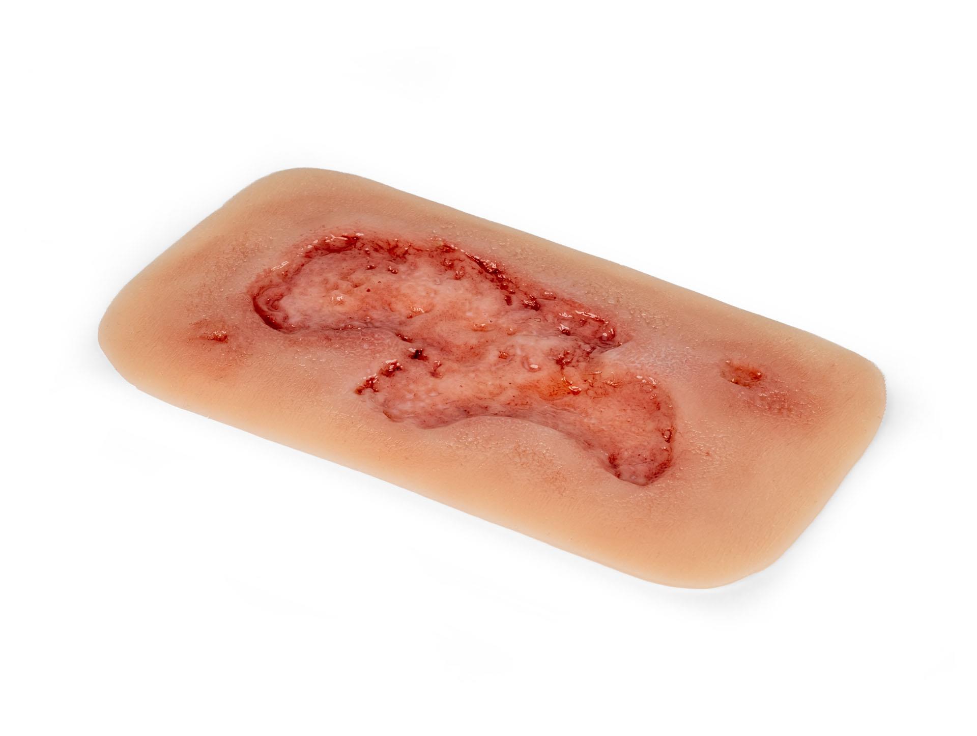Wound-moulage-arterial-leg-ulcer-small-epithelization-phase-3