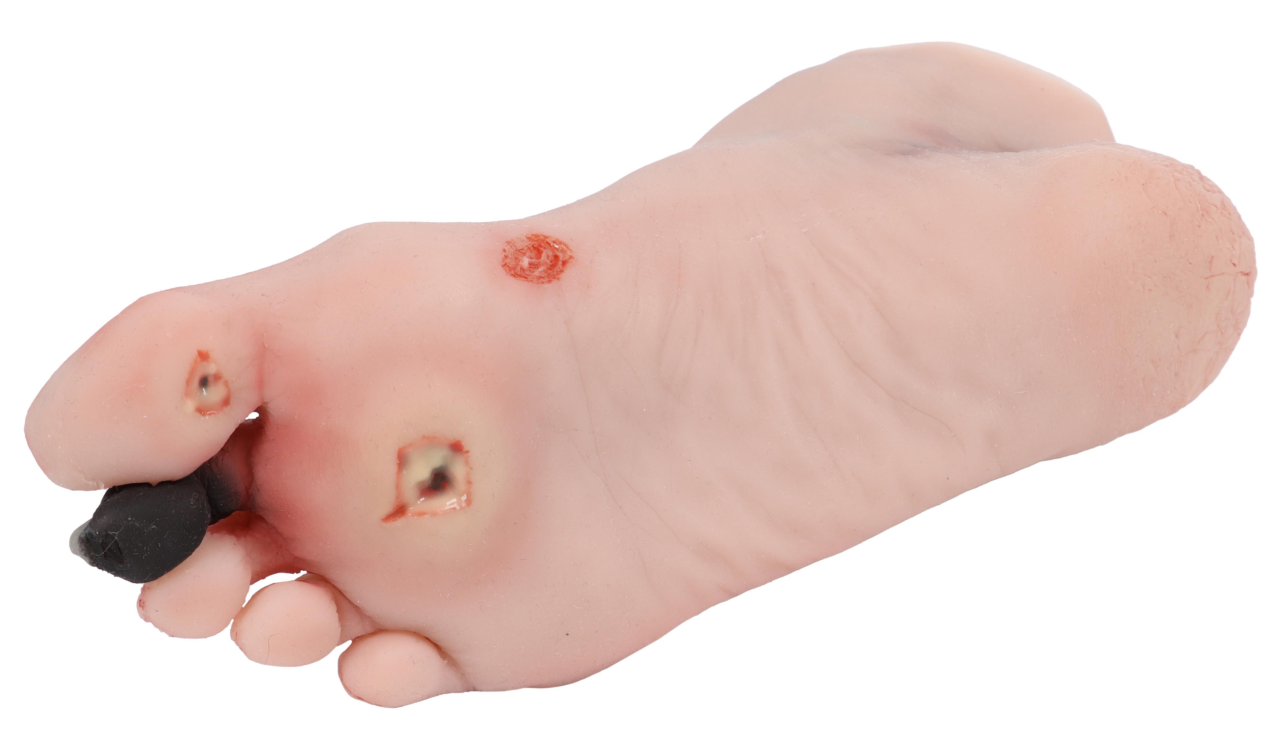 Wound-foot-with-diabetic-foot-syndrome-3
