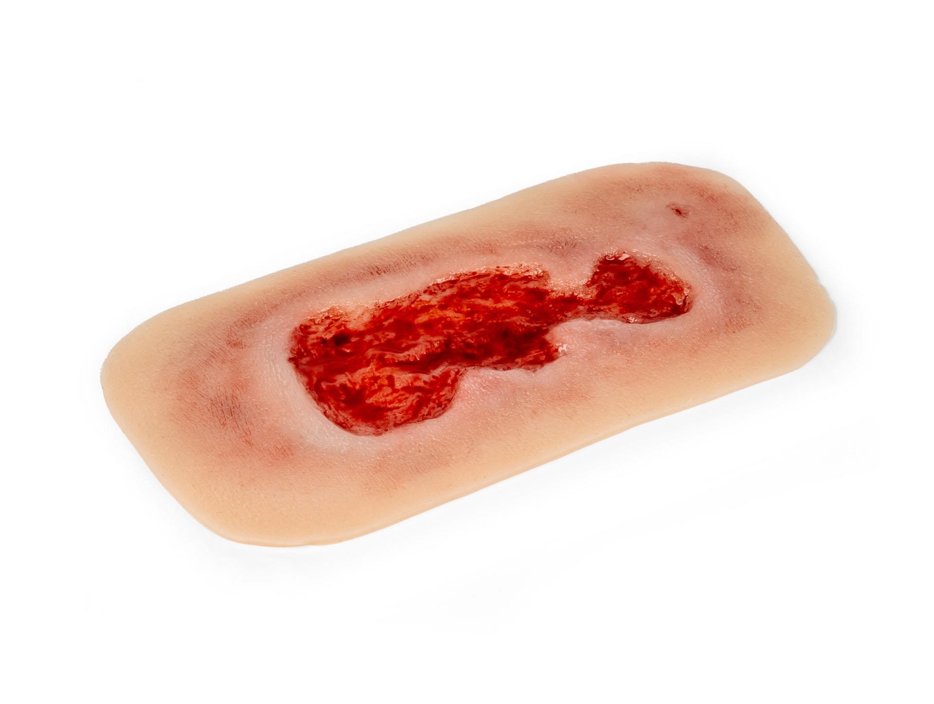 Wound-moulage-venous-leg-ulcer-small-granulation-phase-2