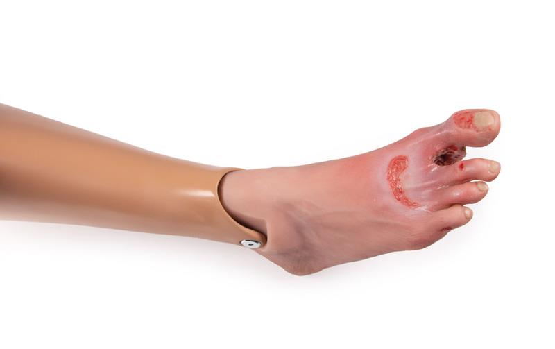 Wundenfuß-mit-diabetischem-Fußsyndrom-fortg-Stadium-für-Nursing-Anne-10