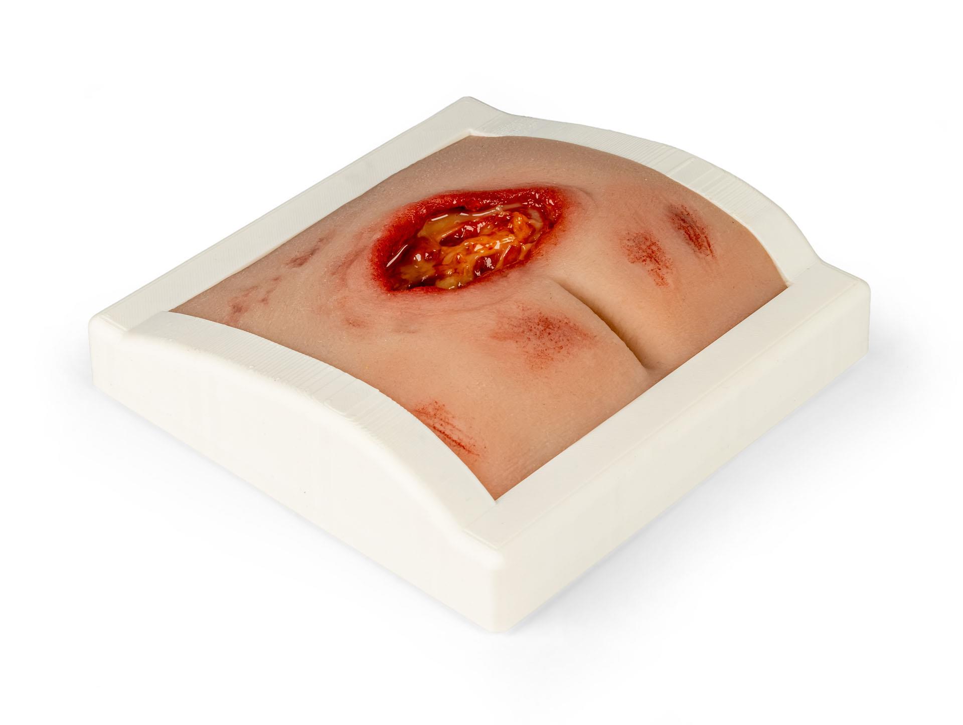 Wound-moulage-sacral-decubitus-cleaned-including-stand-1