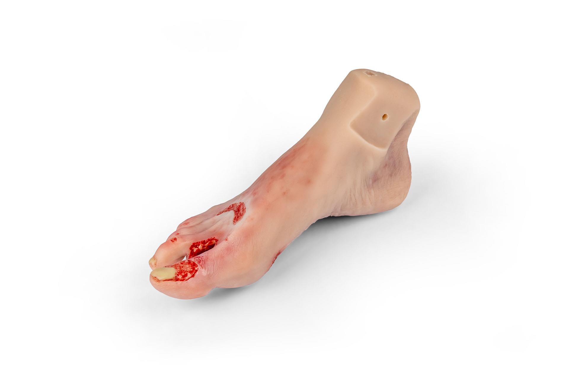 Wundenfuß-mit-diabetischem-Fußsyndrom-fortg-Stadium-für-Nursing-Anne-2