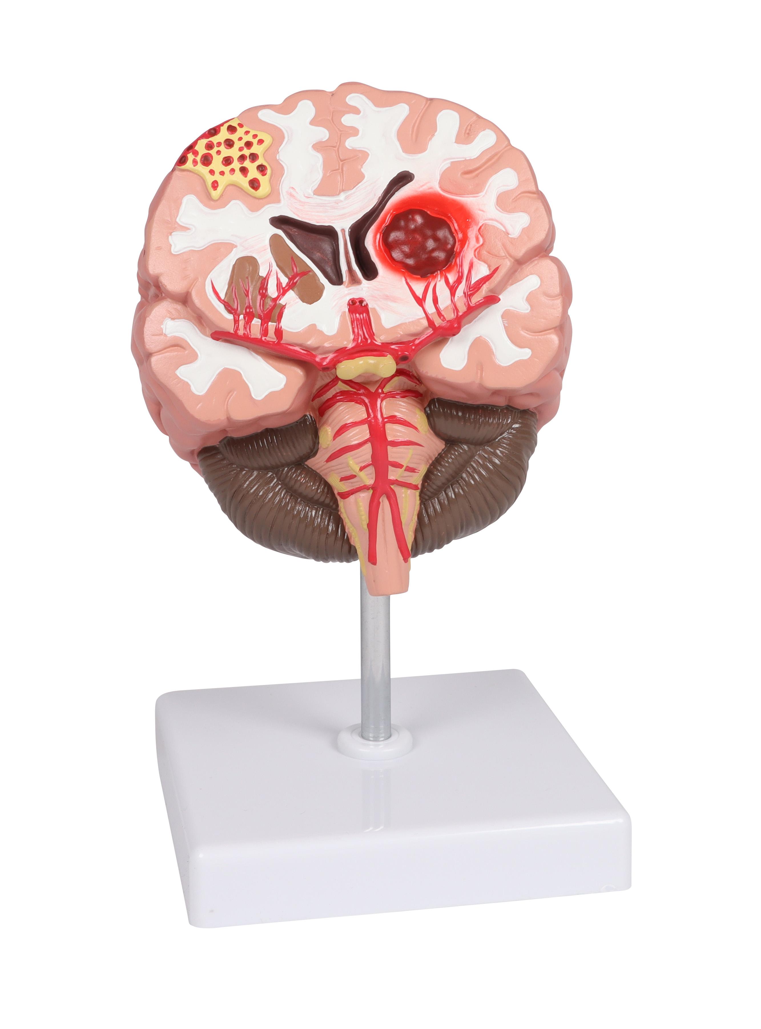 Pathologien-des-Gehirns-lebensgröße-1