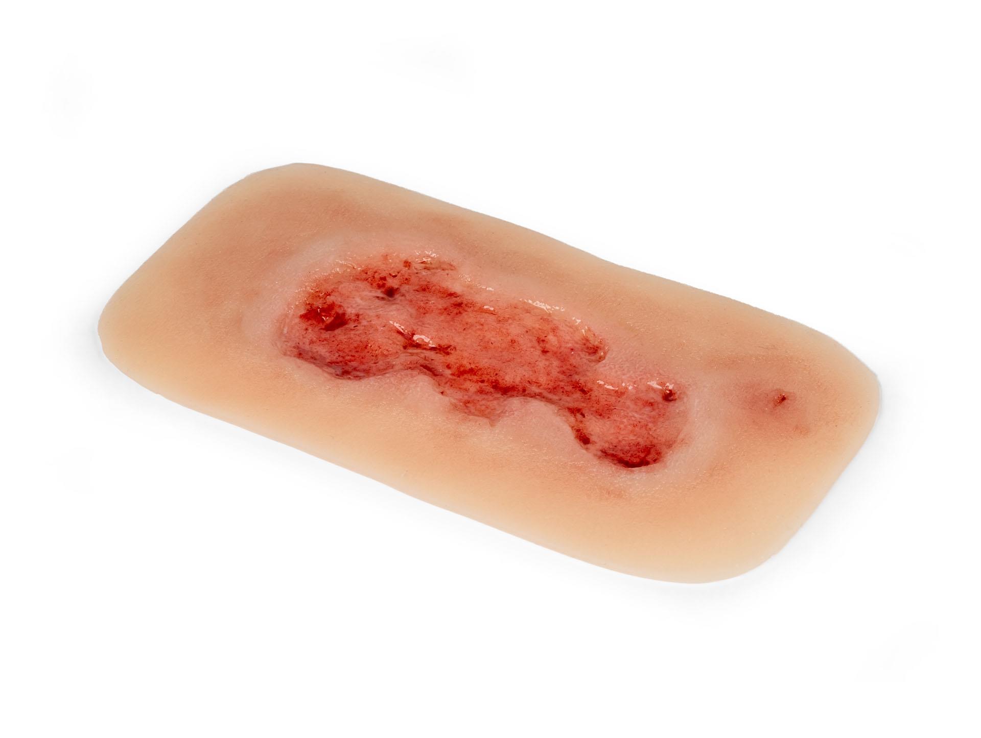 Wound-moulage-venous-leg-ulcer-small-epithelisation-phase-3