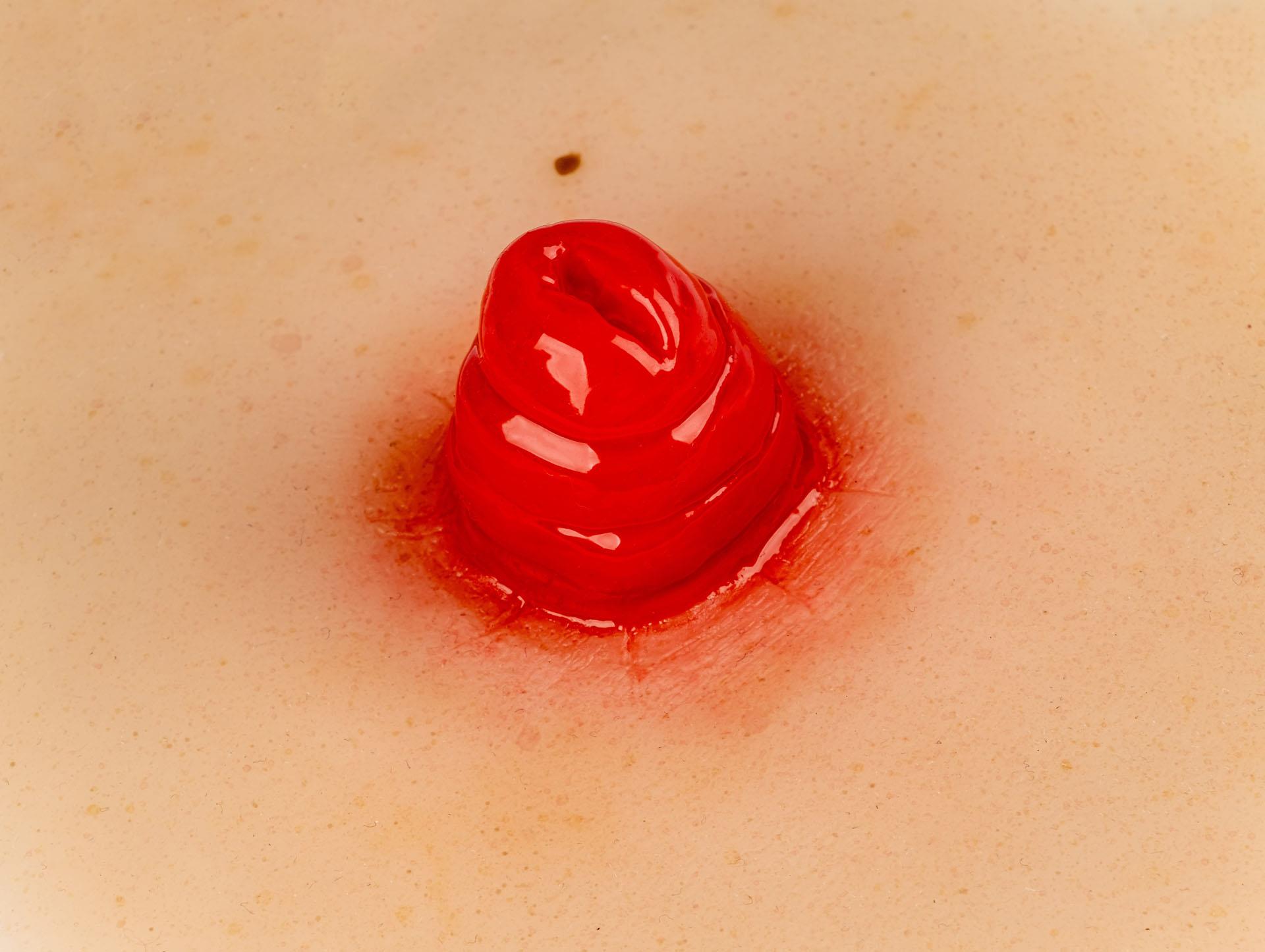 Ileostomy-wound-moulage-self-adhesive-1