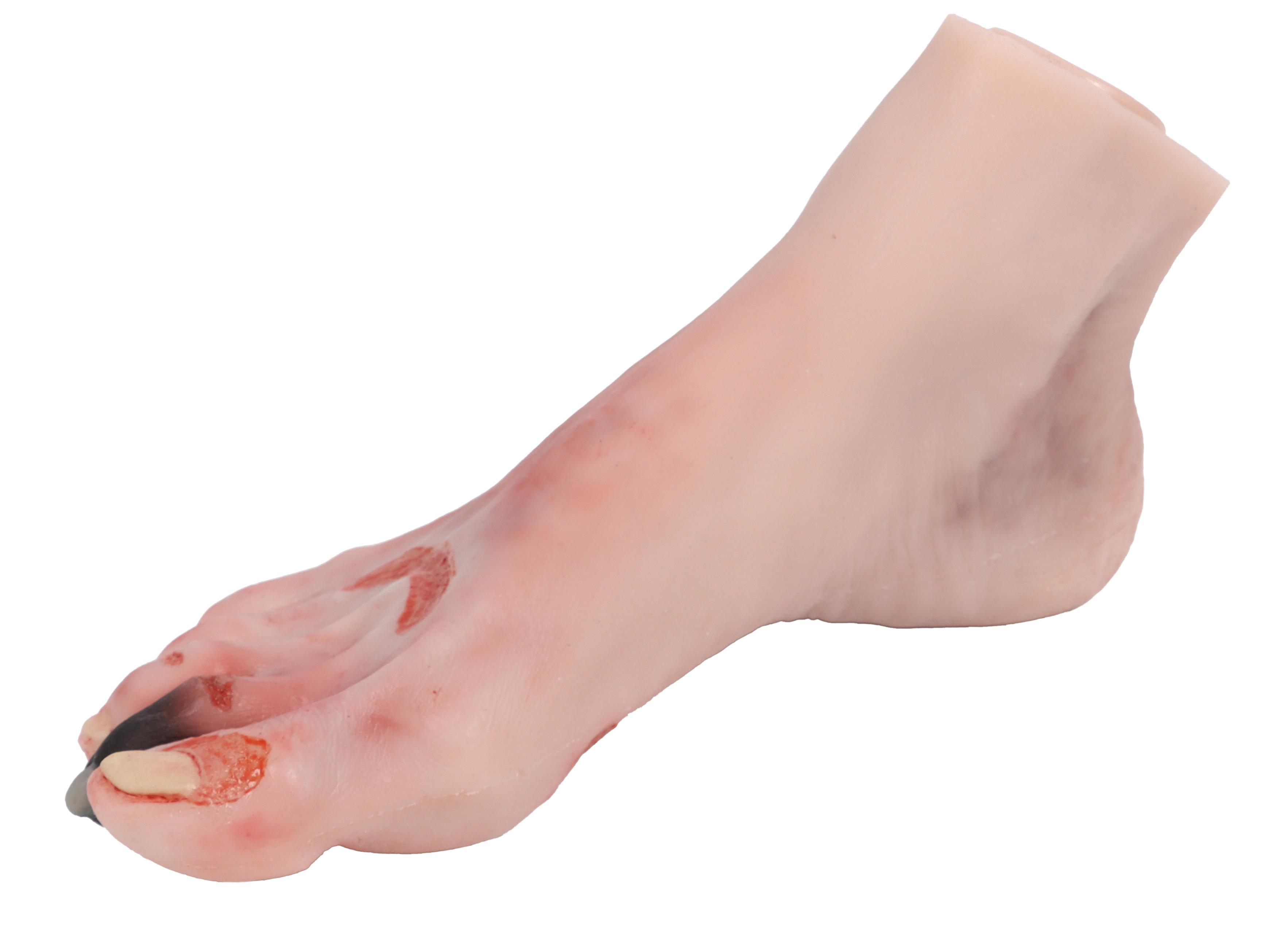 Wound-foot-with-diabetic-foot-syndrome-2