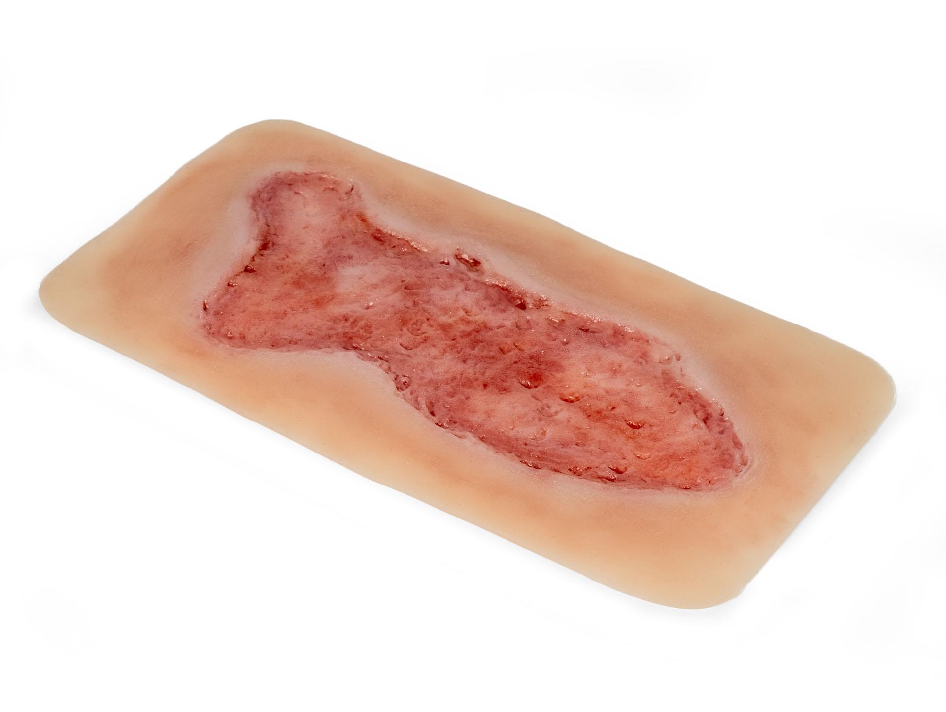 Wound-moulage-venous-leg-ulcer-large-epithelisation phase-3