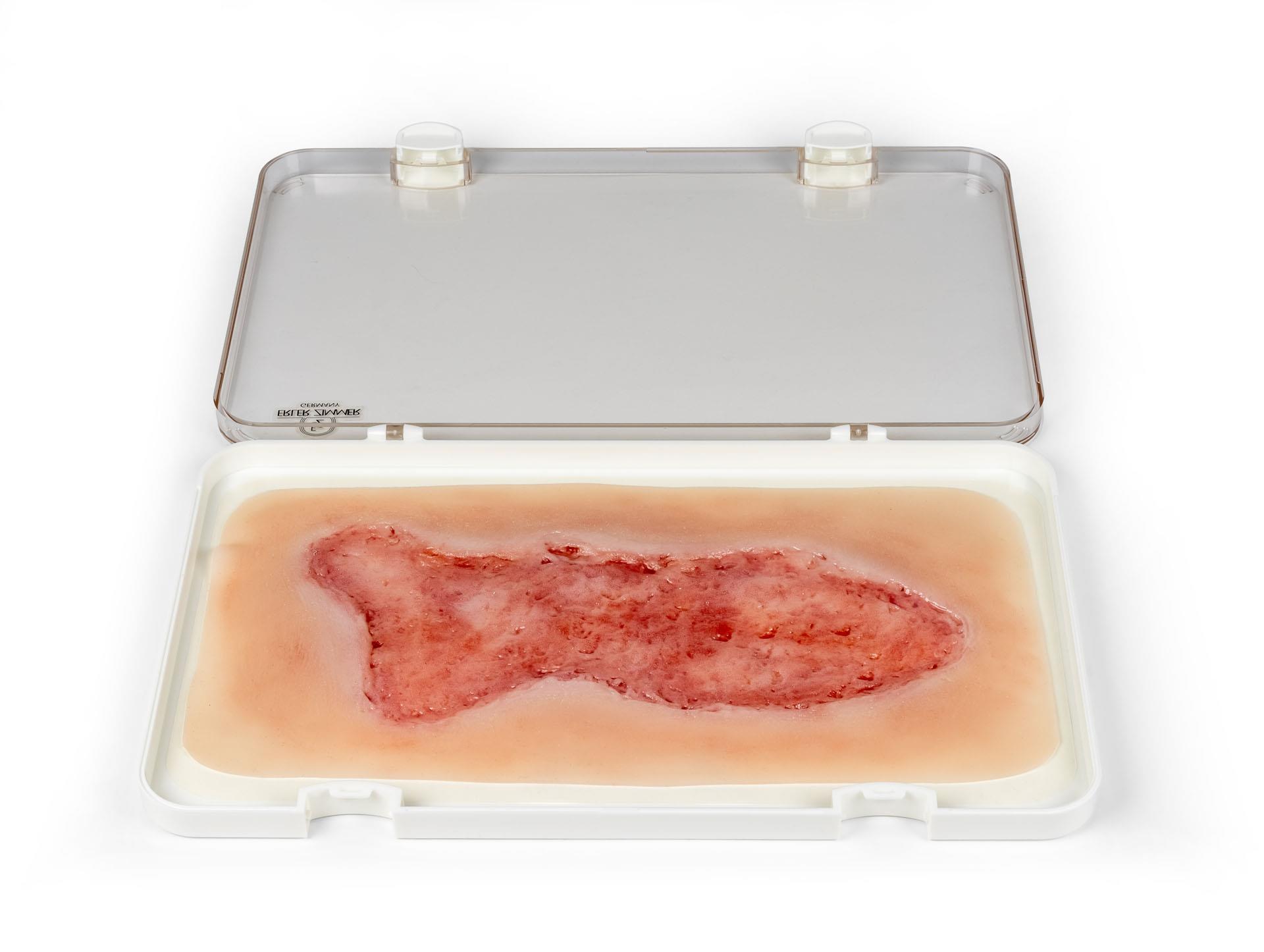 Wundmoulage-Ulcus-Cruris-Venosum-groß-Epithelisierungsphase